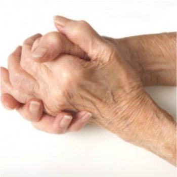 arthritic hands